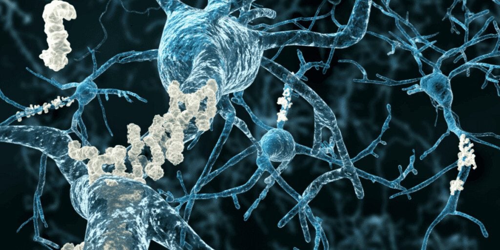 Alzheimer's disease - neurons with amyloid plaques